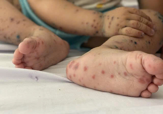 Chặn đường lây bệnh tay chân miệng